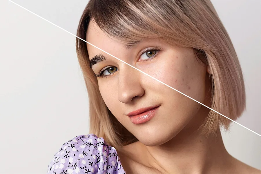 Face and body chemical peel